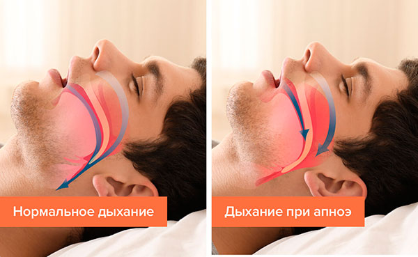 Апноэ сна